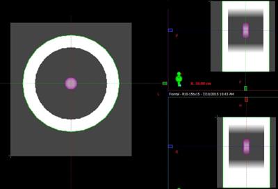 Simulation of dosimetric consequences of intrafraction variation of tumor drift in lung cancer stereotactic body radiotherapy